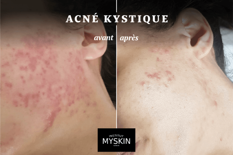 Qu'est-ce l'acné kystique ? - Institut Myskin