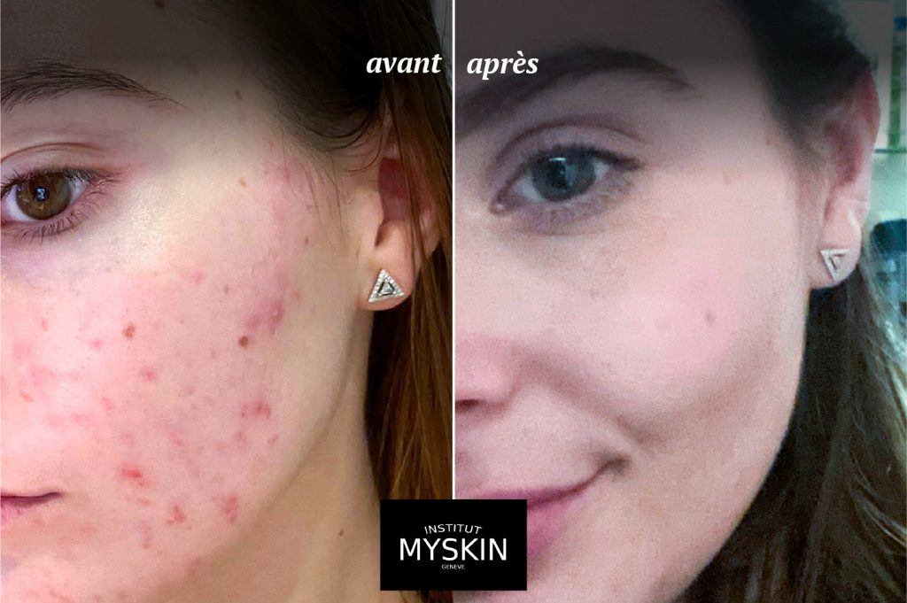 Les Cicatrices Dacn Traitements Par L Institut Myskin Gen Ve