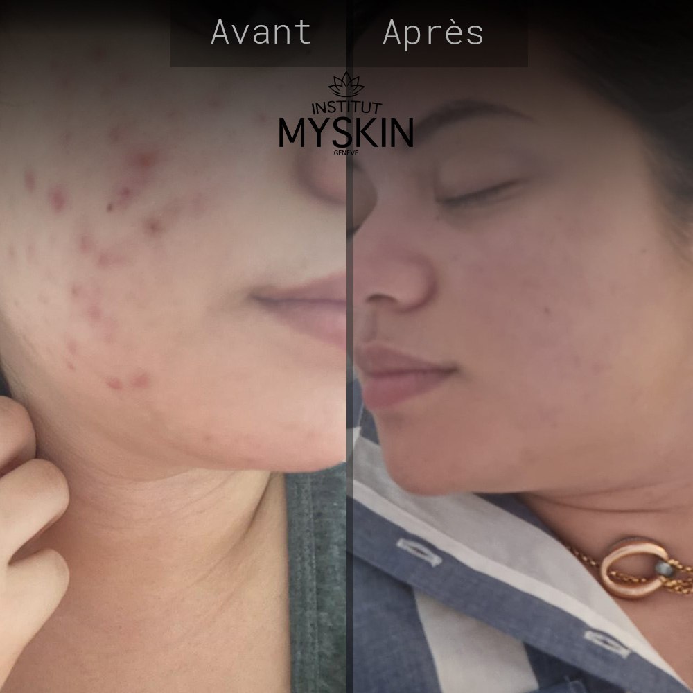 Soins visage traitement acné avant/après