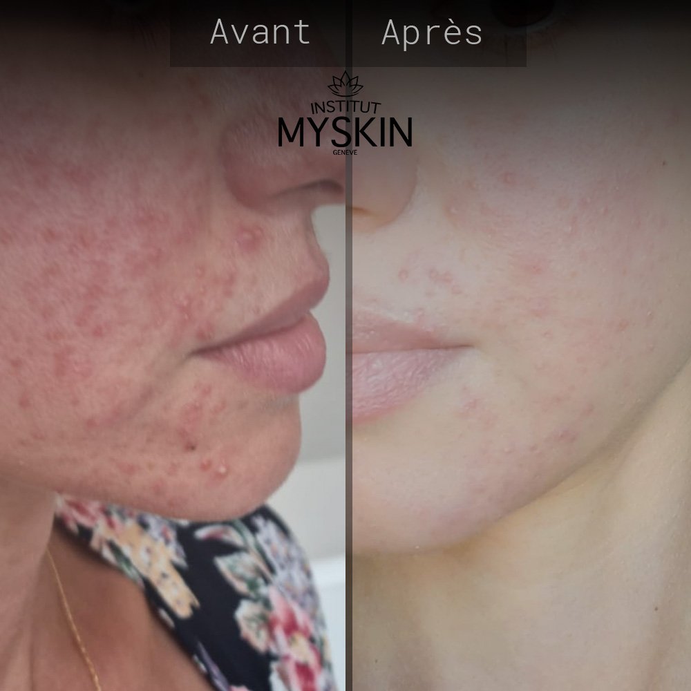 Soins visage traitement acné avant/après