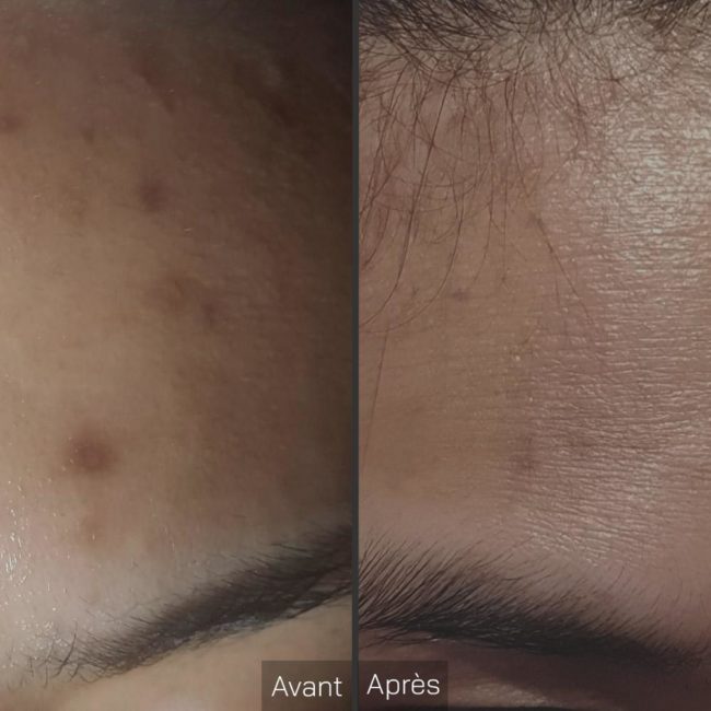 acne front geneve suisse