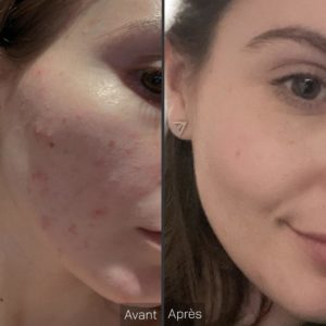 acne joues geneve suisse