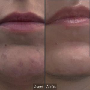 acne menton geneve suisse