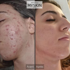 acne traitement geneve suisse institut de beaute