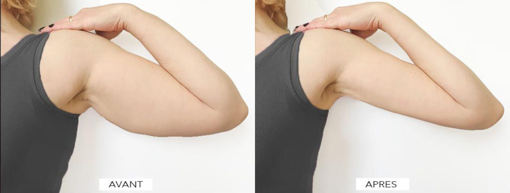 Radiofréquence cavitation avant après bras