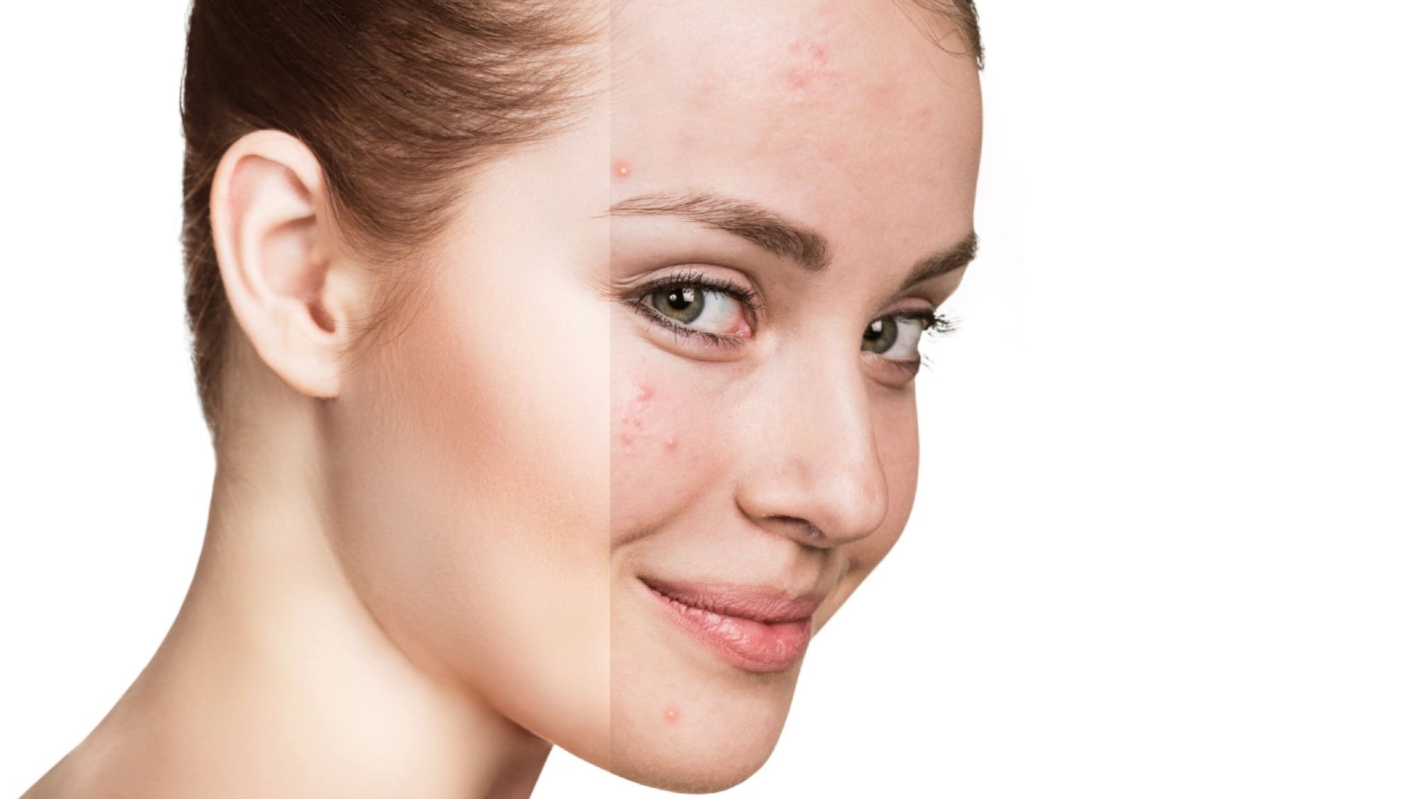 Peaux sensibles à tendance acnéique - Institut My Skin Genève