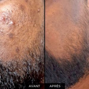 meilleur traitement acné homme Genève Suisse